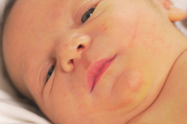 Colostro Ajuda a Prevenir a Icterícia em Bebês Colostro Ajuda a Prevenir a Icterícia em Bebês